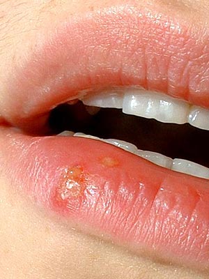 fever blister lip