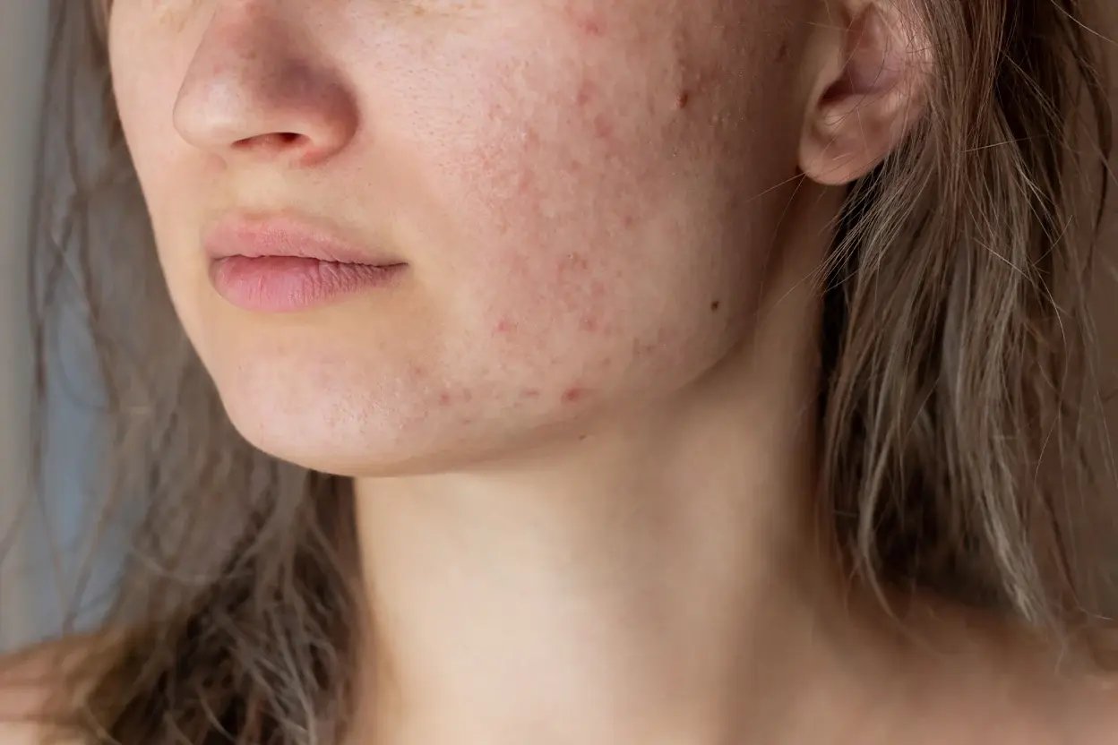 AAD - Acne - Banner copy