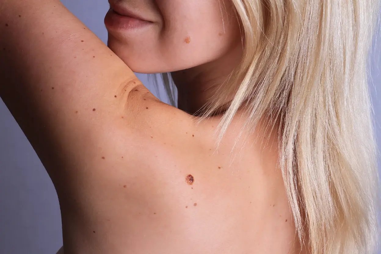 AAD - Birthmarks - Banner copy