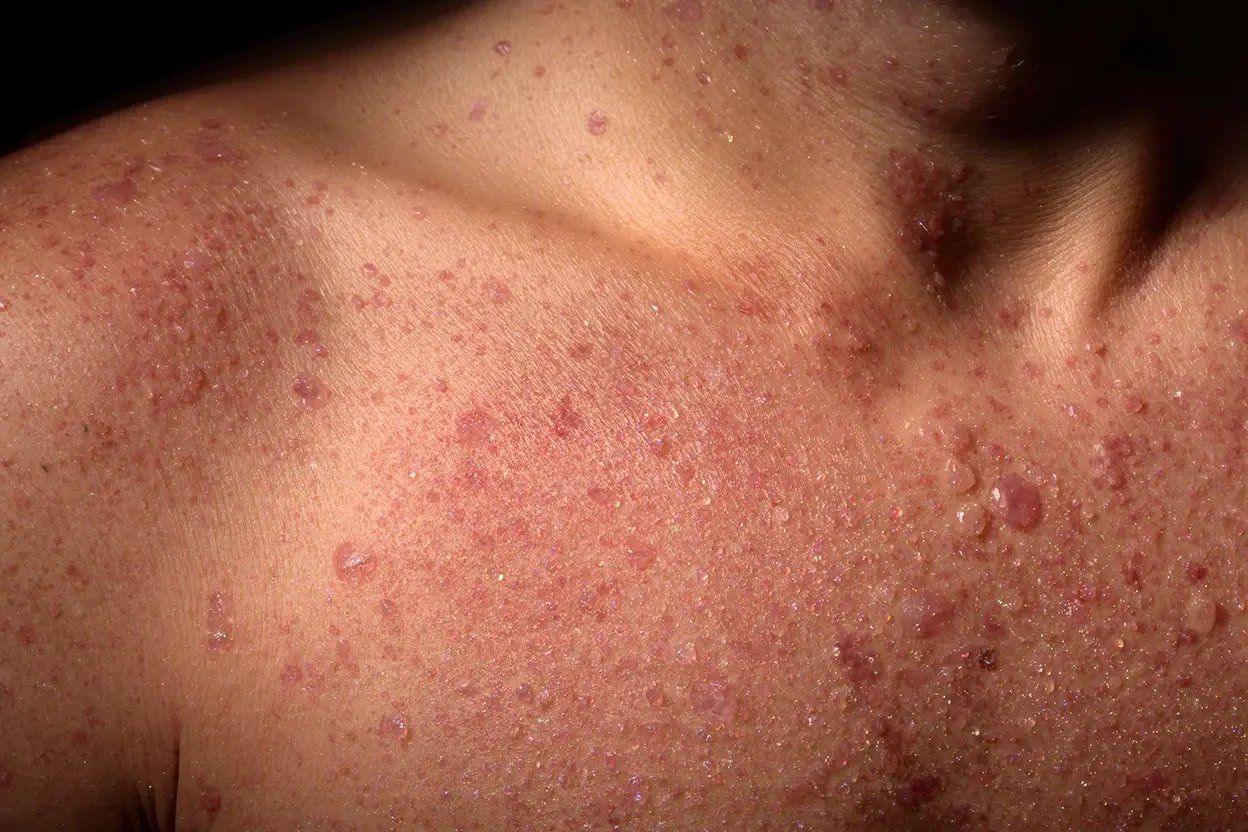 AAD - Hidradenitis Suppurativa - Banner copy