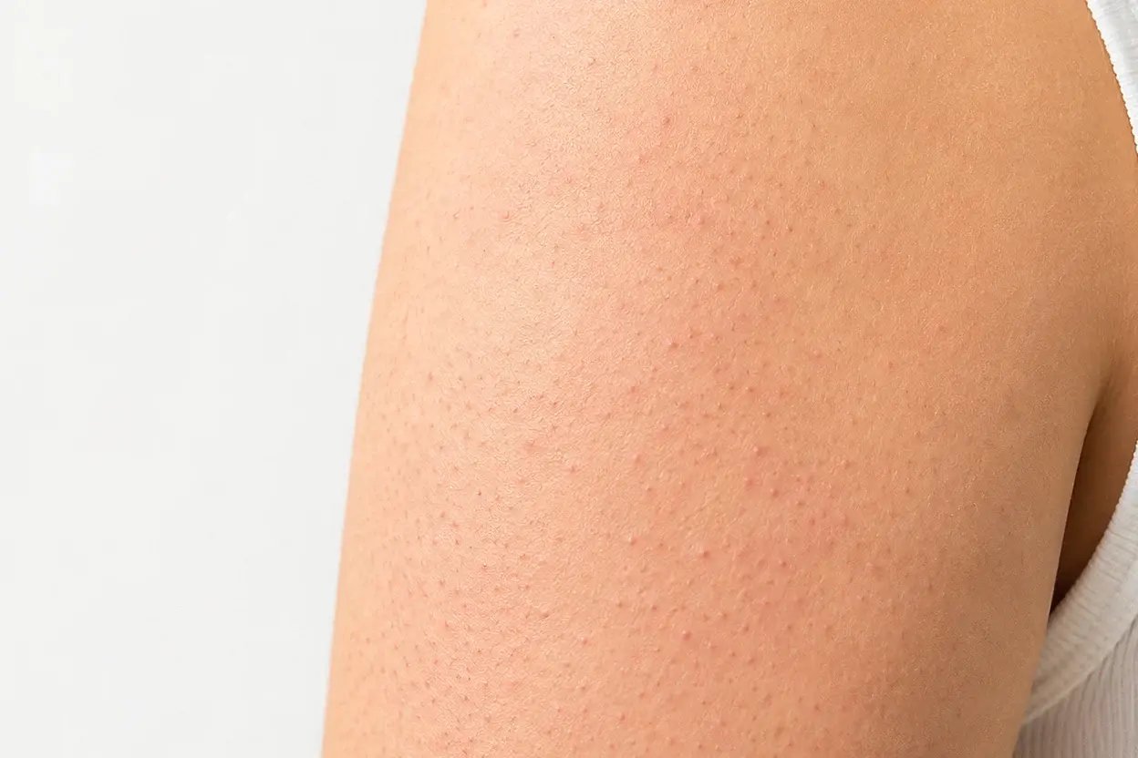 AAD - Keratosis Pilaris - Banner copy