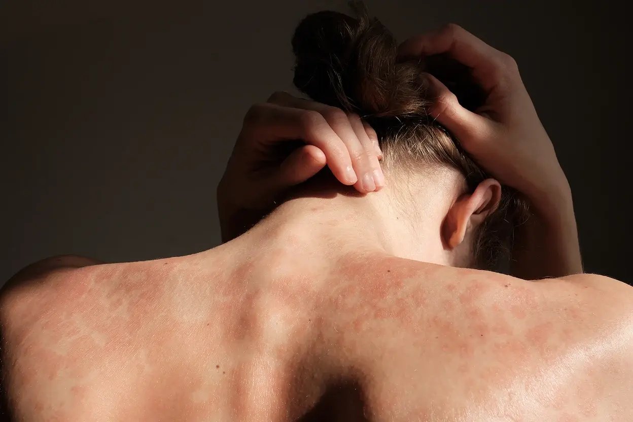AAD - Psoriasis - Banner copy
