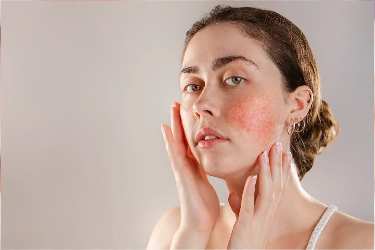 AAD - Rosacea - Banner copy