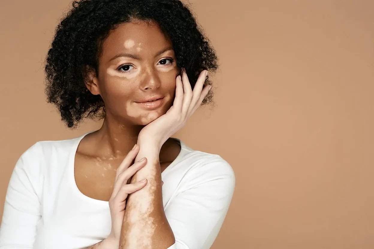 AAD - Vitiligo- Banner copy