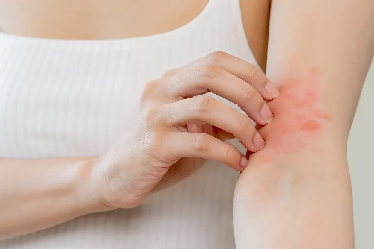 AAD - eczema- Banner copy