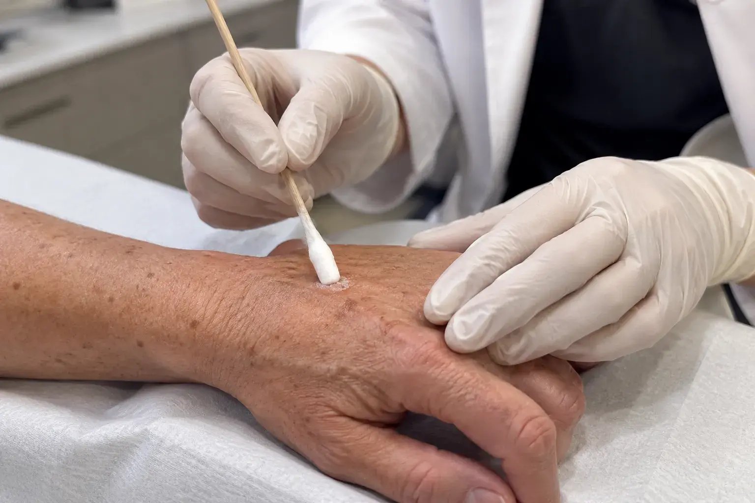Dermatologist Treating Hand Lesion