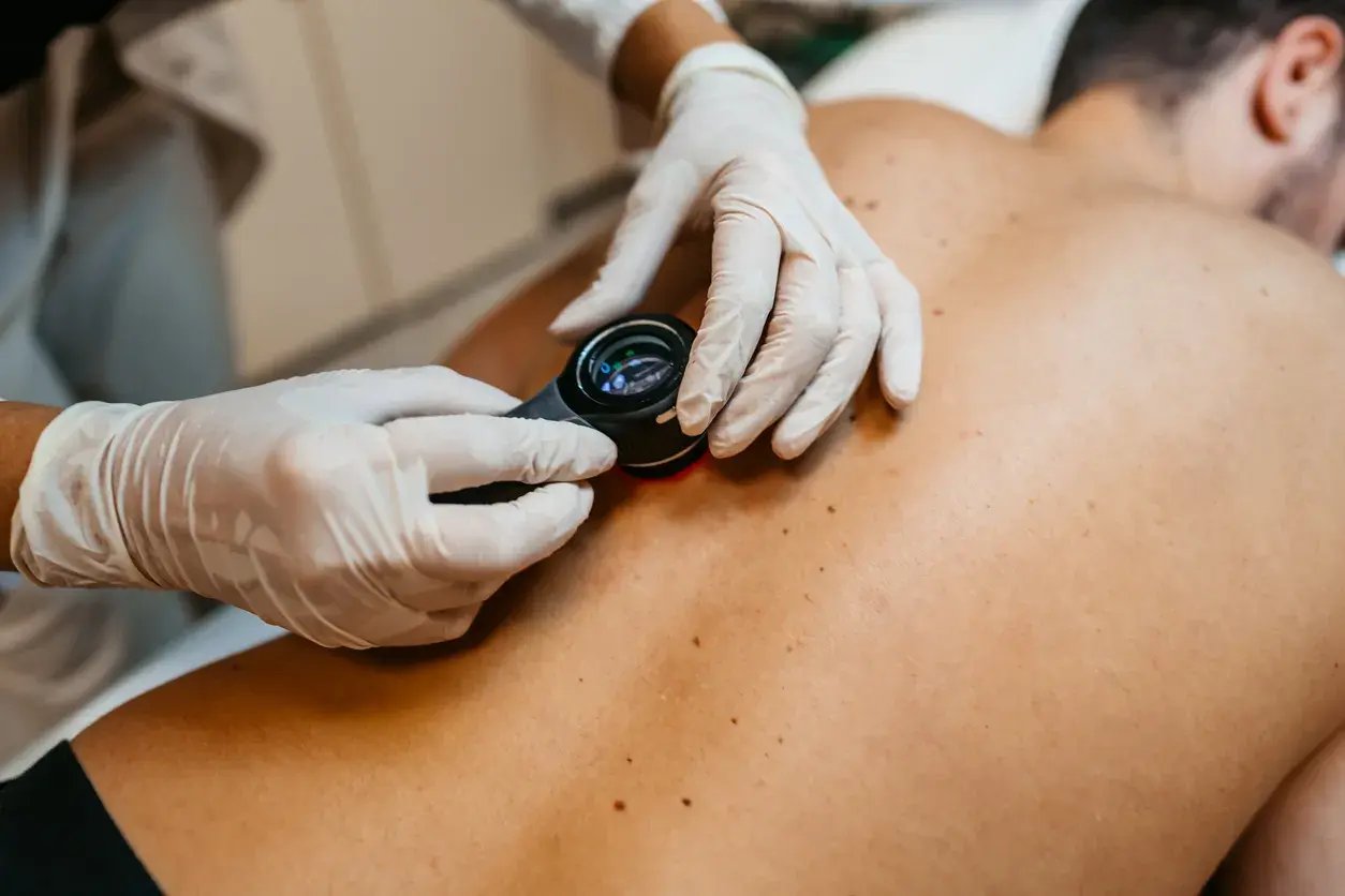 Dermatology - Conditions - Warts istockphoto-1437090427-2048x2048