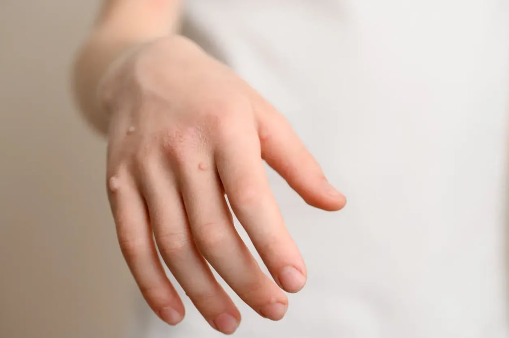 Dermatology - Conditions - Warts istockphoto-2180297393-1024x1024