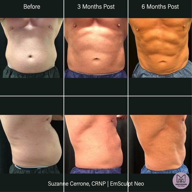 Progression of man's abdomen after EmSculpt Neo