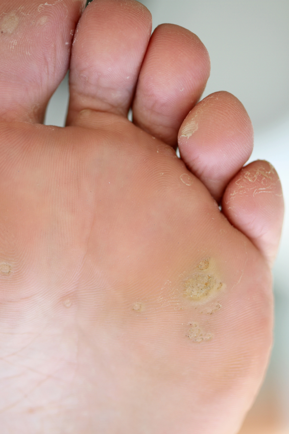 How can you treat corns on your toes?