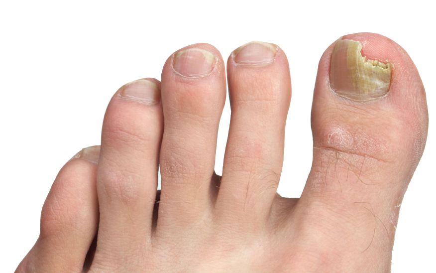 toenail-fungus-treatments-in-maryland-anne-arundel-dermatology