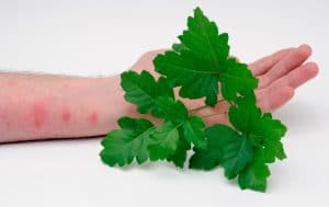 Treating Poison Ivy, Oak and Sumac