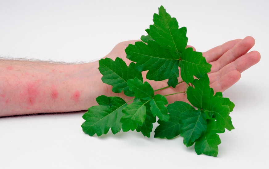 Poison Ivy, Oak And Sumac Rash Treatment, Anne Arundel, 46% OFF