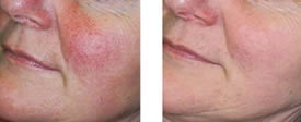Before and After Photo Rejuvenation Treatments