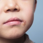Impetigo, Common Toddler Skin Conditions