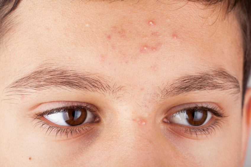 Adolescent skin condition acne