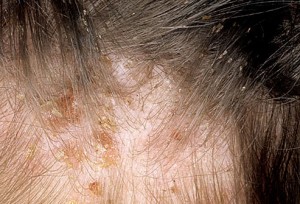 Child with Head Lice Infestation