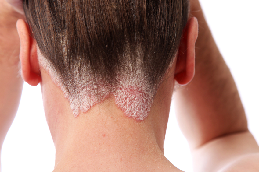psoriasis on the hairline and on the scalp in children