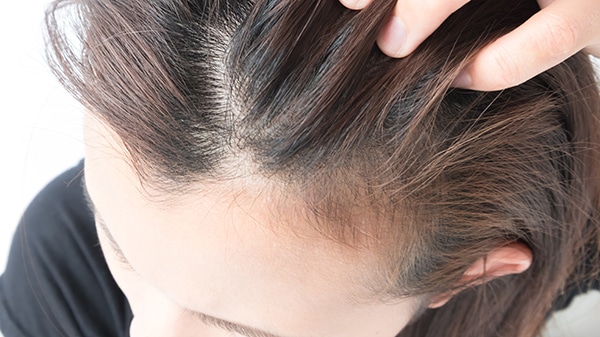 Telogen Effluvium Hair Loss Treatment, Anne Arundel Dermatology