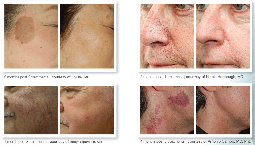 Can BBL Treatments Remove Acne Scars?, Blog