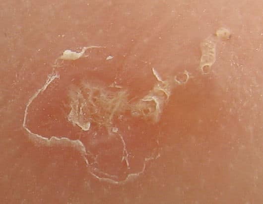 What Is Scabies About Scabies Symptoms Treatments And More