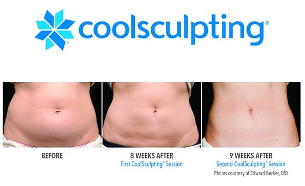 Coolsculpting Side Effects  Everything You Need To Know