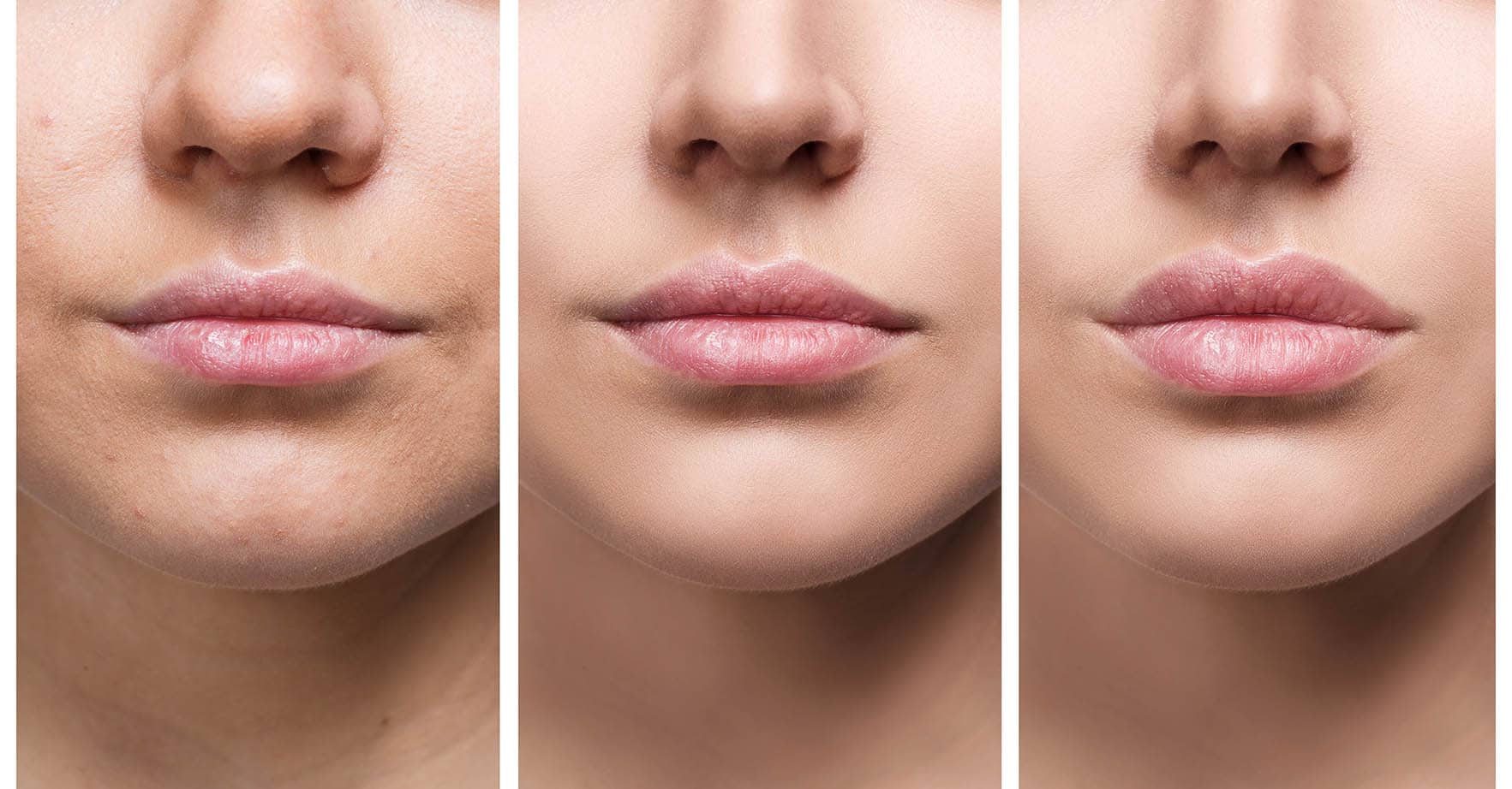 Lip Flip Vs. Lip Filler Know the Difference