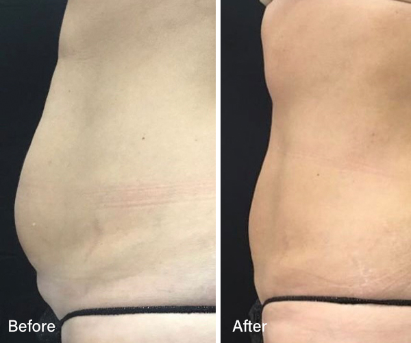 Tummy Tuck in Maryland  Abdominoplasty Mount Airy, MD