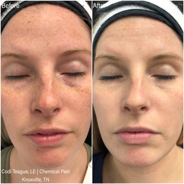 Before and after photos of female face with sun damage and melasma on the left and no damage on the right after the chemical peel