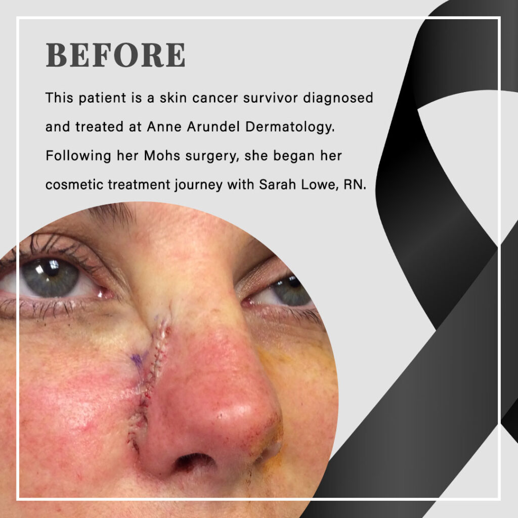 BEFORE This patient is a skin cancer survivor diagnosed and treated at Anne Arundel Dermatology. Following her Mohs surgery, she began her cosmetic treatment journey with Sarah Lowe, RN.