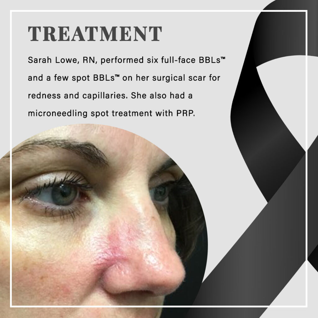 TREATMENT Sarah Lowe, RN, performed six full-face BBLs™ and a few spot BBLs™ on her surgical scar for redness and capillaries. She also had a microneedling spot treatment with PRP.