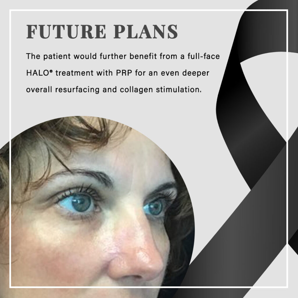FUTURE PLANS The patient would further benefit from a full-face HALO® treatment with PRP for an even deeper overall resurfacing and collagen stimulation.