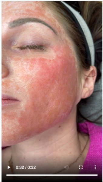 Different⁣ Types of ⁢Scars ⁤Red Light Therapy Can Treat