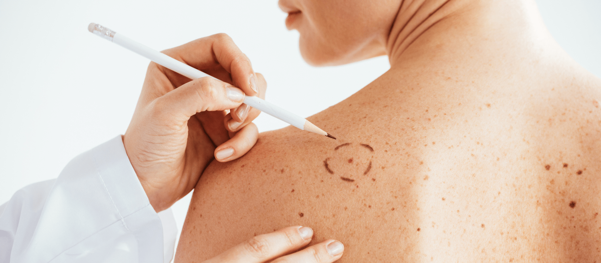 doctor drawing a circle around mole on woman's back to check for skin cancer