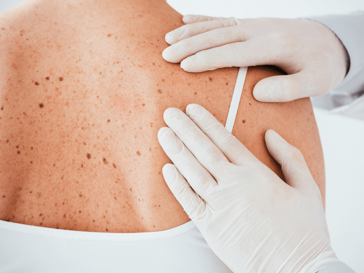 doctor's hands with gloves examining moles on someone's back