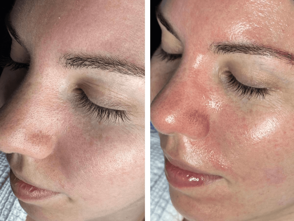 before and after dermaplaning