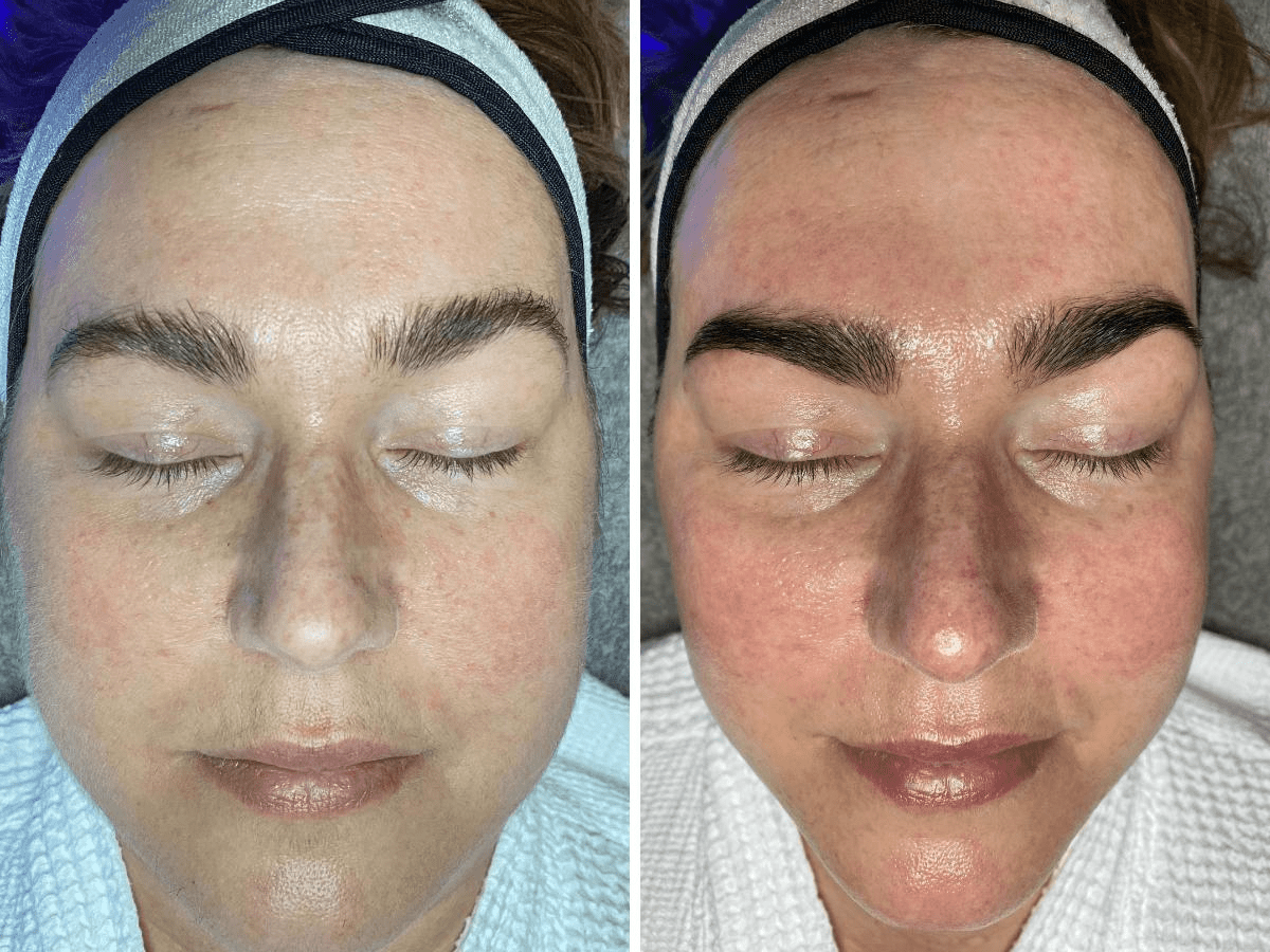 before and after dermaplaning