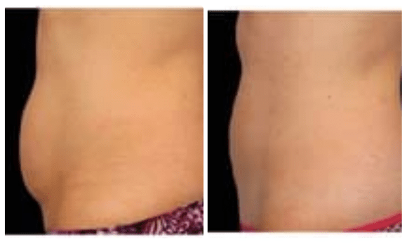 coolsculpt before and after