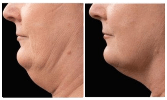 coolsculpt mini before and after