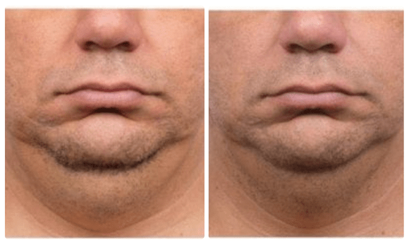 coolsculpt mini before and after