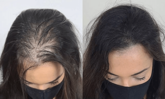 hair growth before and after