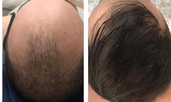 hair growth before and after