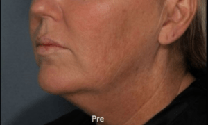 chin without fat