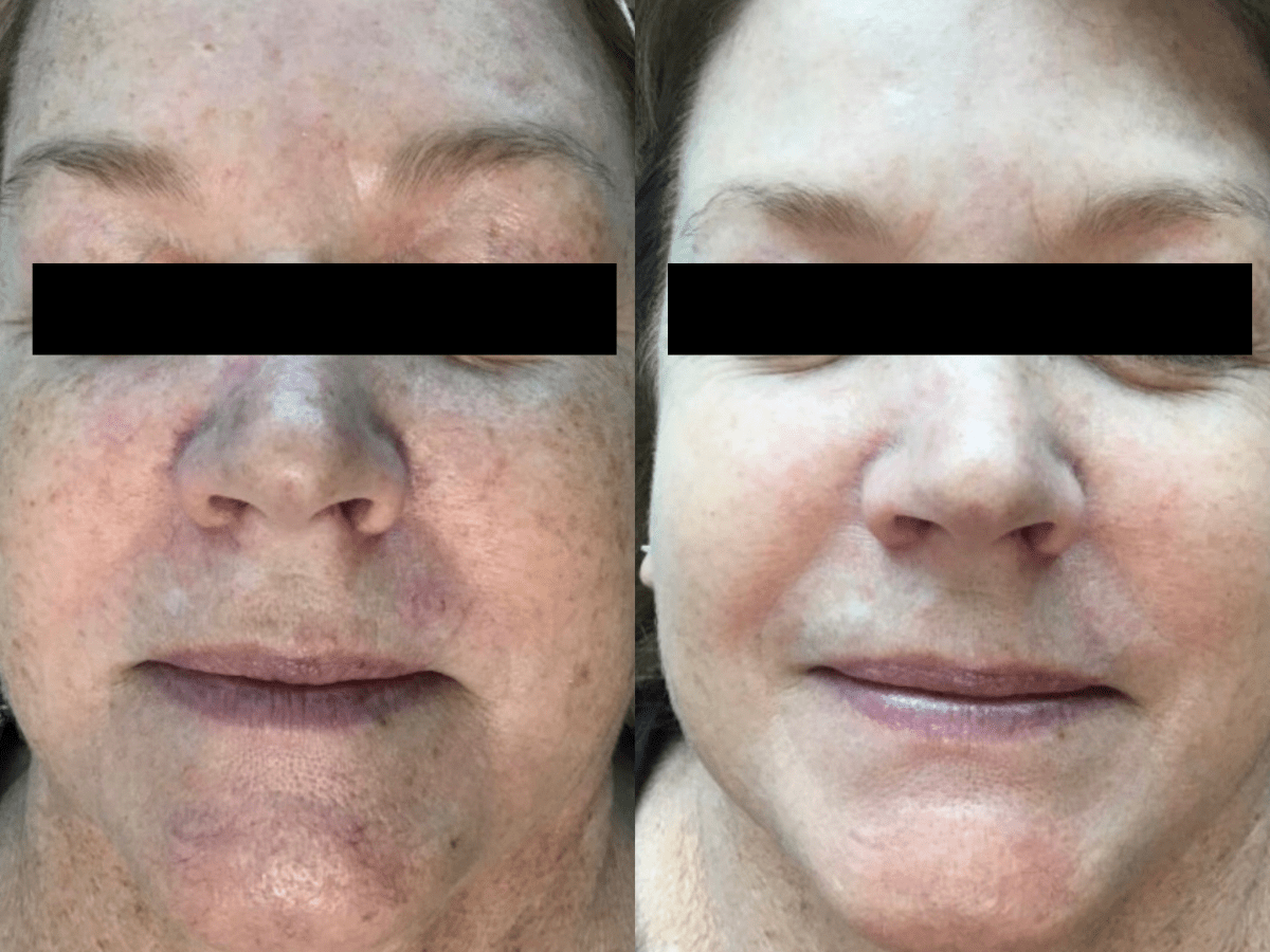 broad band light before and after treatment photos