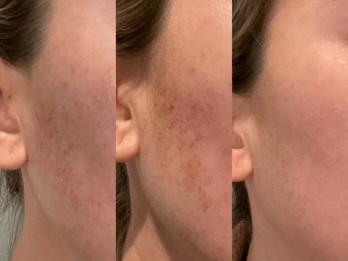 BBL before and after treatment