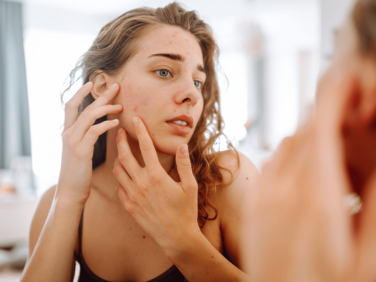 woman with acne looking in mirror