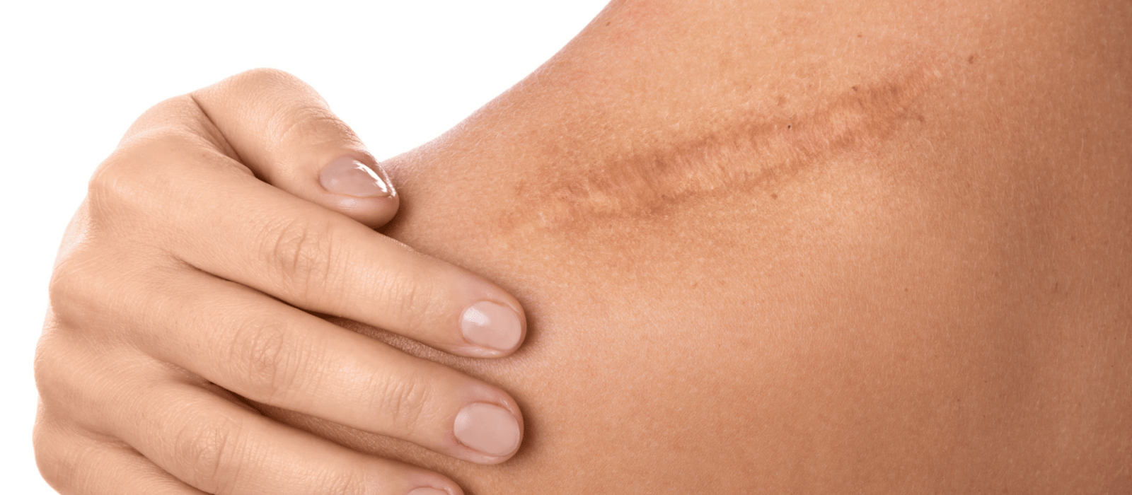 close up of scar on body