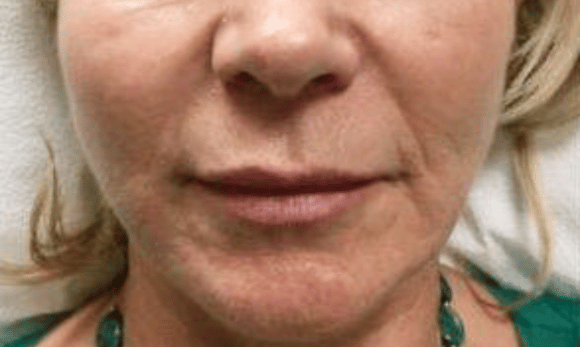 woman with wrinkles on face