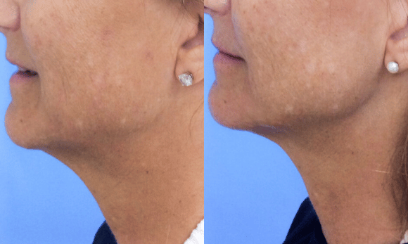 before and after Ultherapy