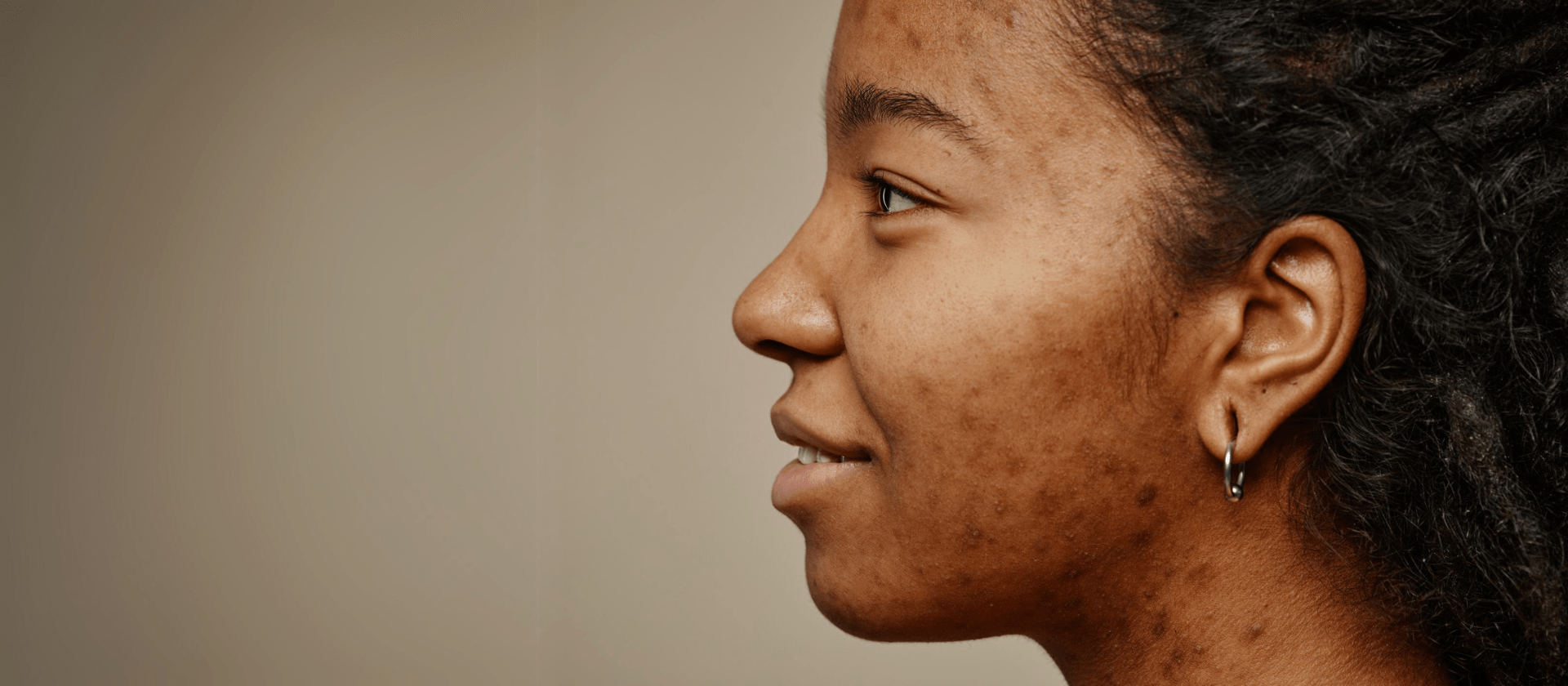 woman's face with acne and acne scarring